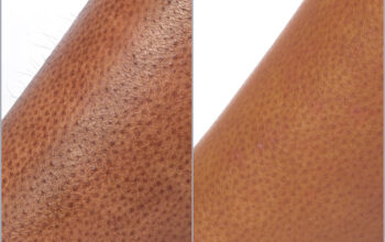 How leg laser hair removal works