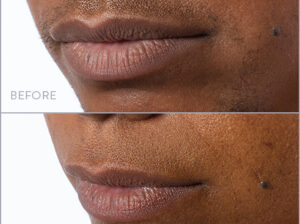 How lip & chin laser hair removal works