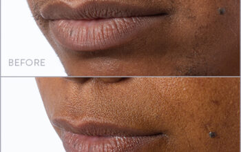 How lip & chin laser hair removal works