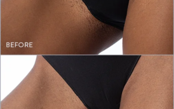 Bikini Line laser hair removal