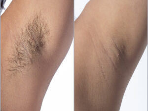 Under arm laser hair removal