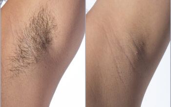 Under arm laser hair removal